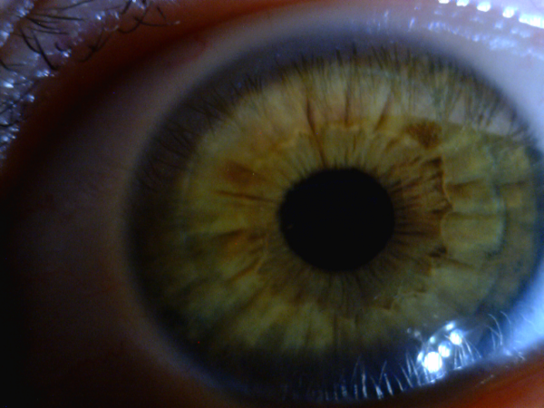 My left eye