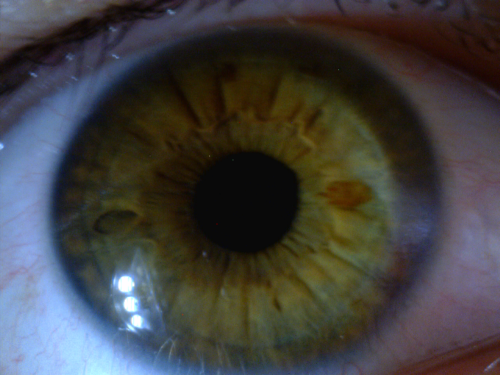 My right eye